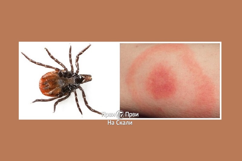 Bolesti koje prenose krpelji i komarci (vektorske zarazne bolesti)